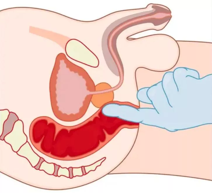 Toucher rectal, pourquoi on le pratique encore ?